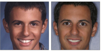 paul before and after orthodontic work