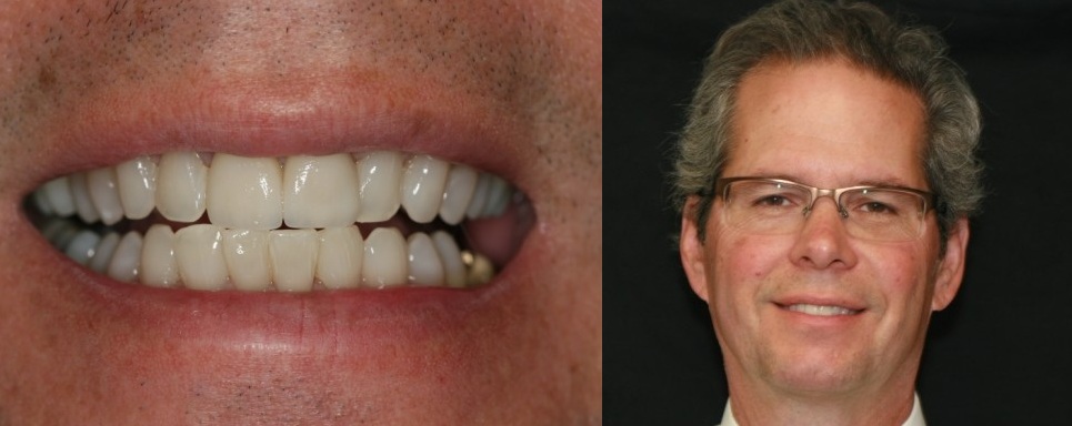 Peter with Dental Crowns Cosmetic Dentistry Makeover