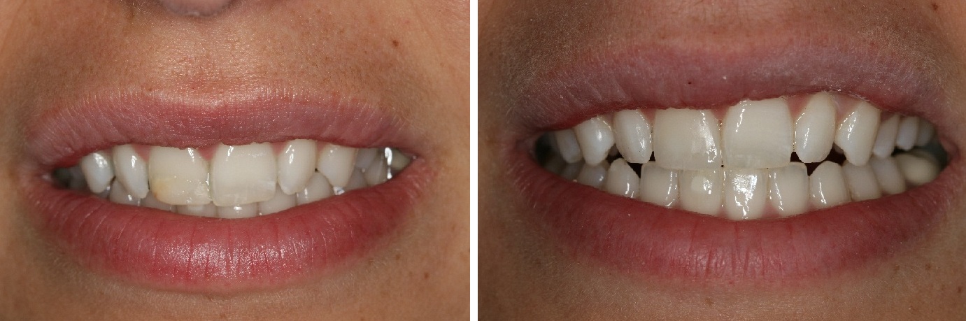 Kasey Before and After Dental Bonding