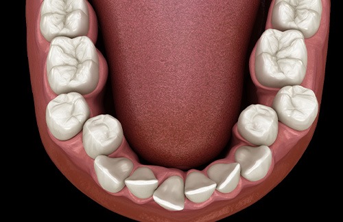Illustration of crooked teeth