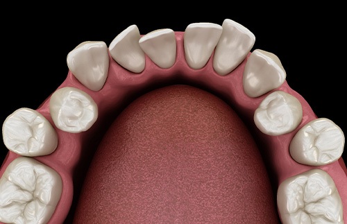Illustration of gapped teeth