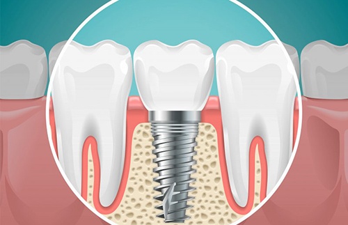 Graphic image of a dental implant anchored to the jawbone