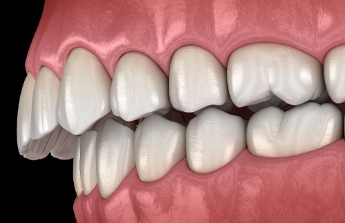 Illustration of an overbite