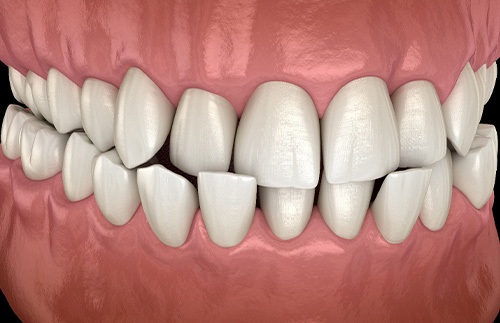 Illustration of a crossbite