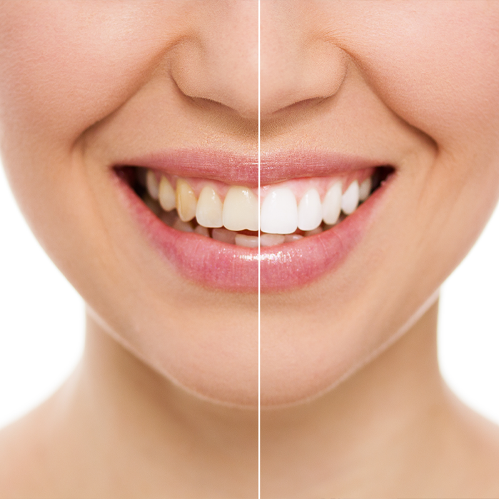 Dentist performing teeth whitening on patient