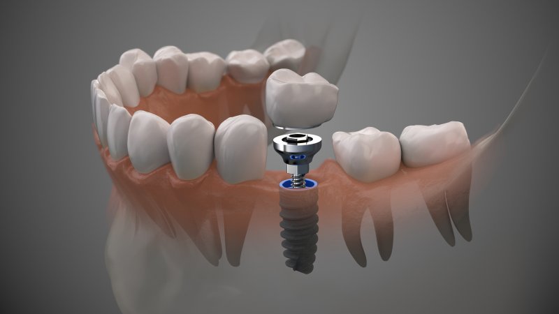 digital image of a single dental implant